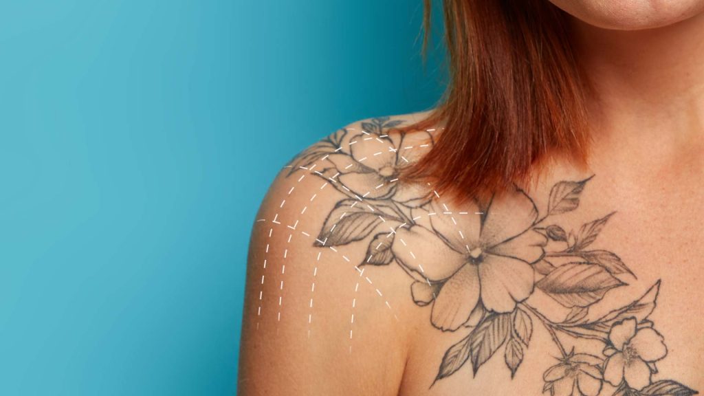 Pro Tattoo Removal : XL TriStar
