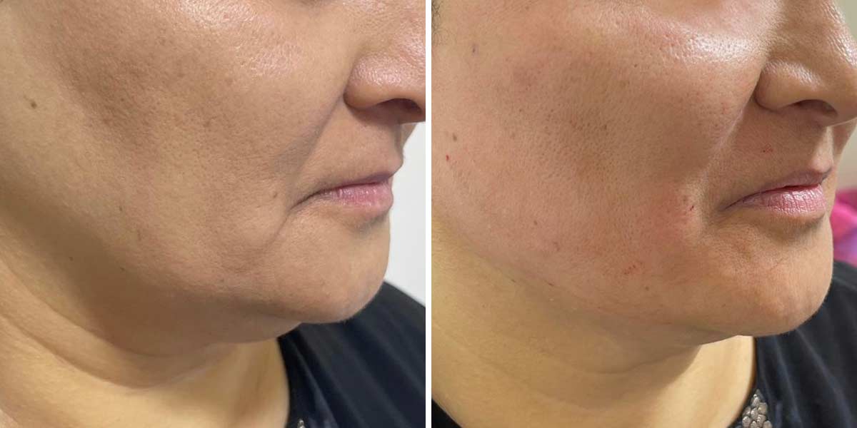EndoLaser-Before-After-02