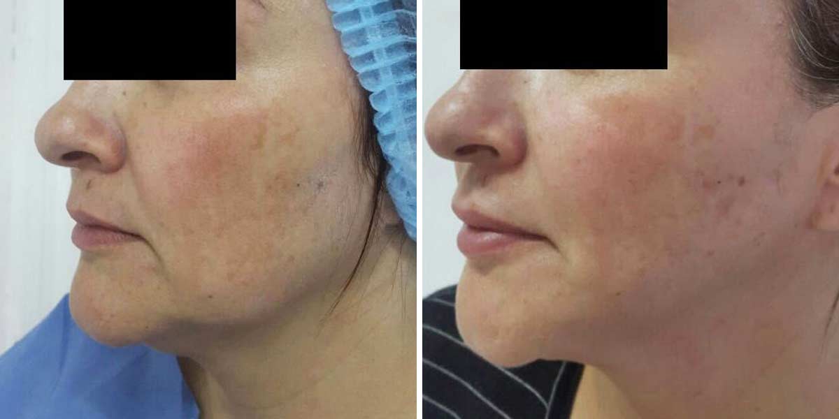 EndoLaser-Before-After-05