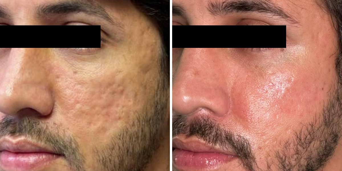 EndoLaser-Before-After-07