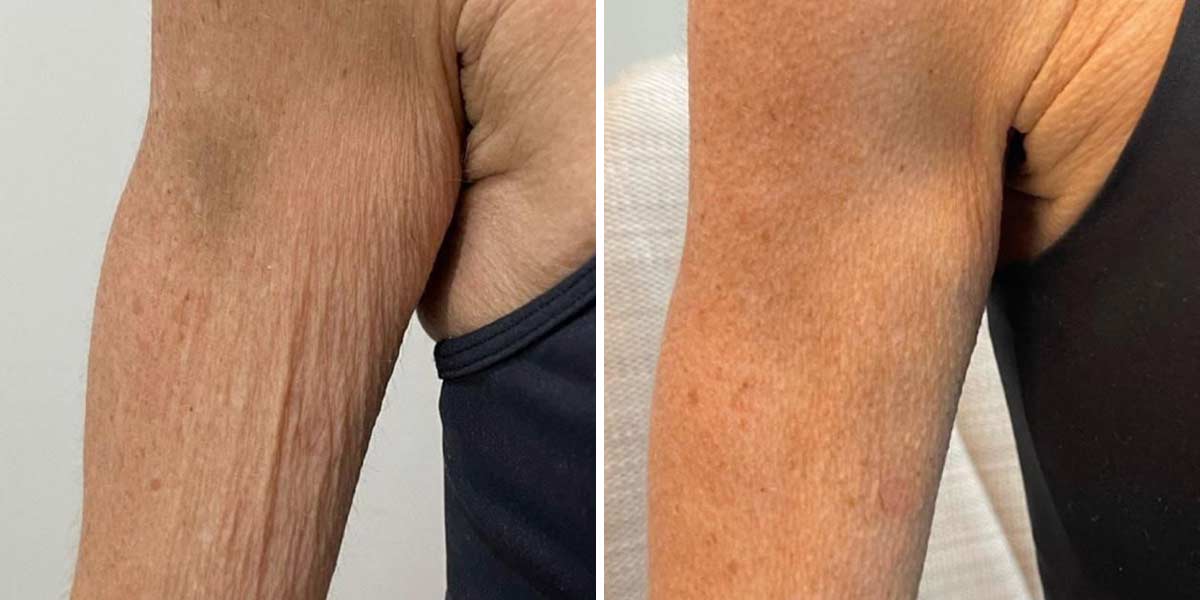 EndoLaser-Before-After-10