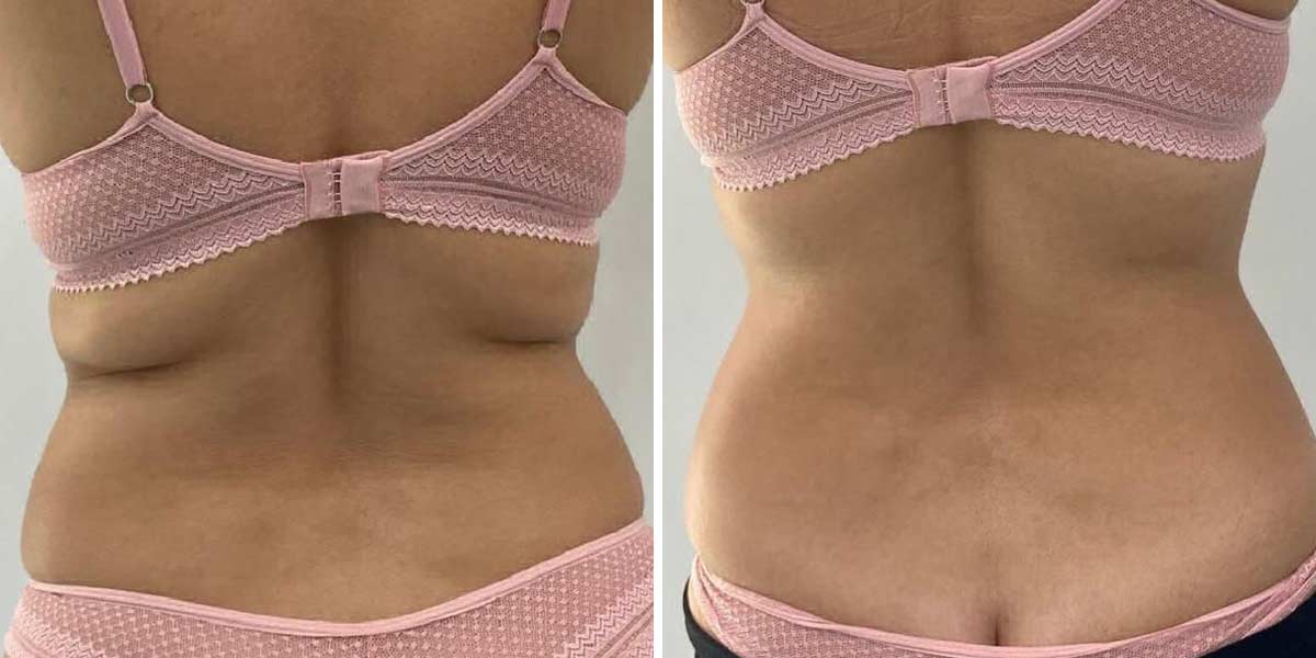 EndoLaser-Before-After-11