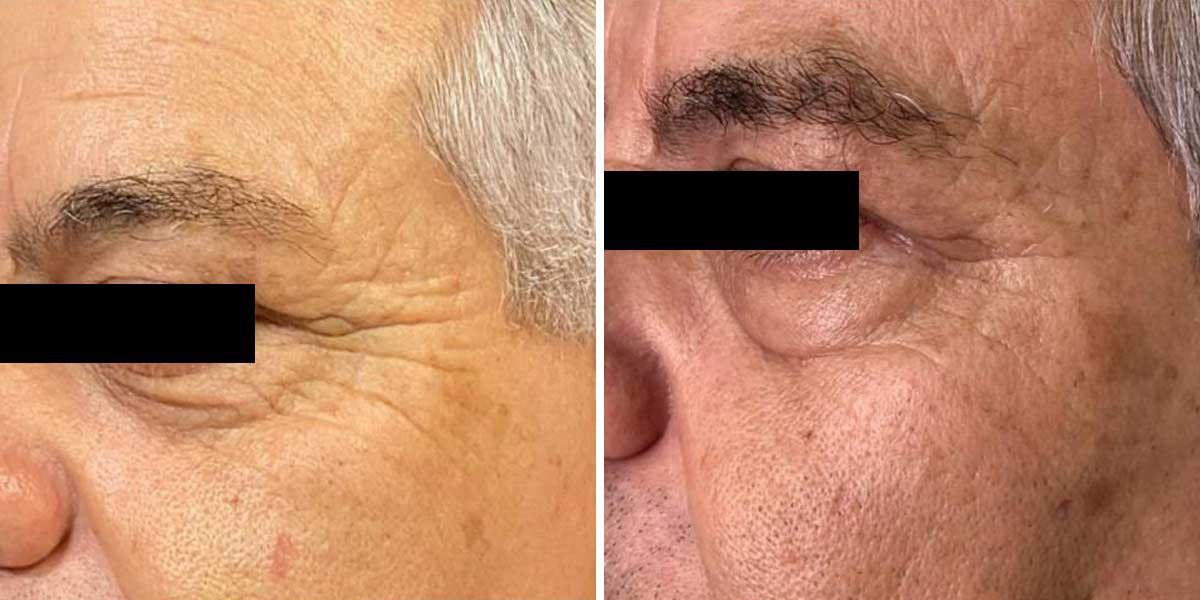 EndoLaser-Before-After-12